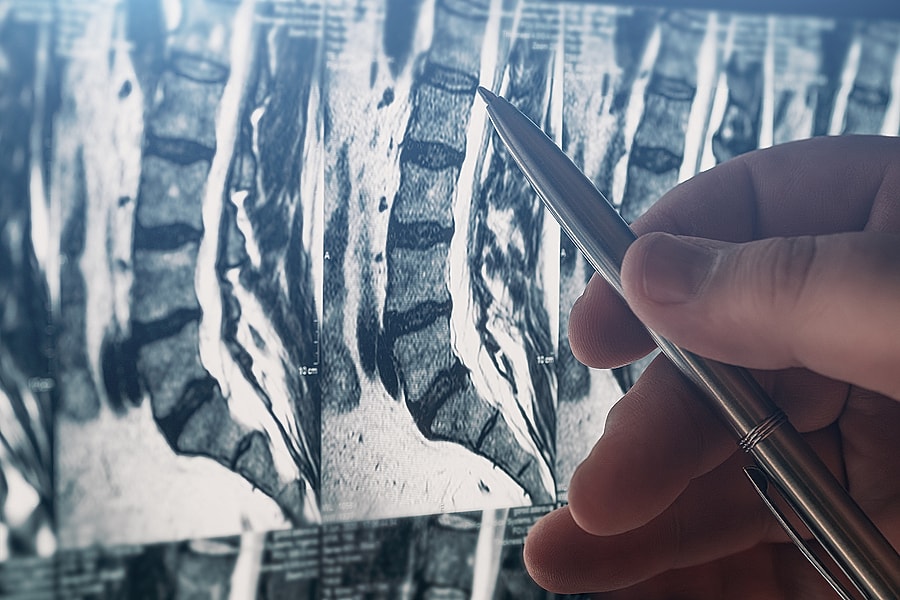 Degenerative Disc Disease Symptoms, Causes, and Treatment