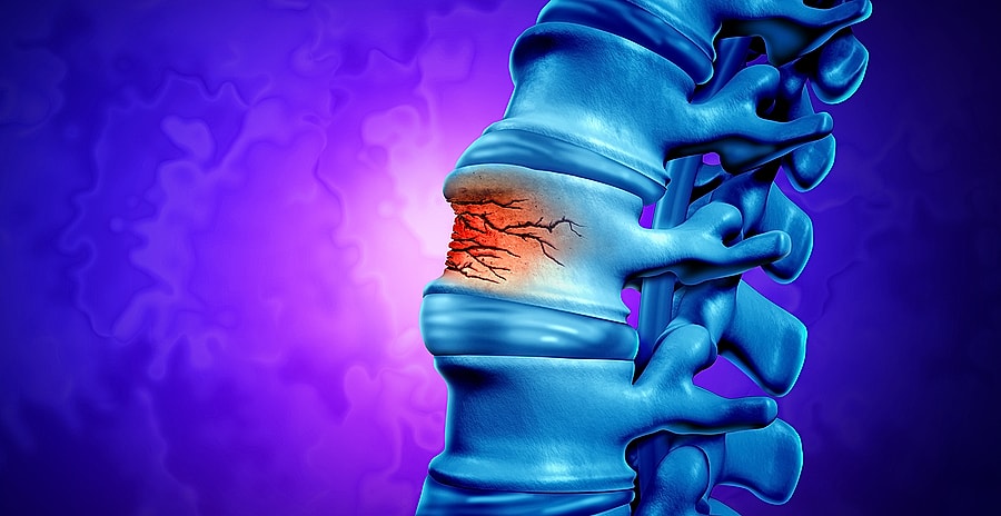 Don’t Ignore Long Term Effects of Spinal Compression Fractures