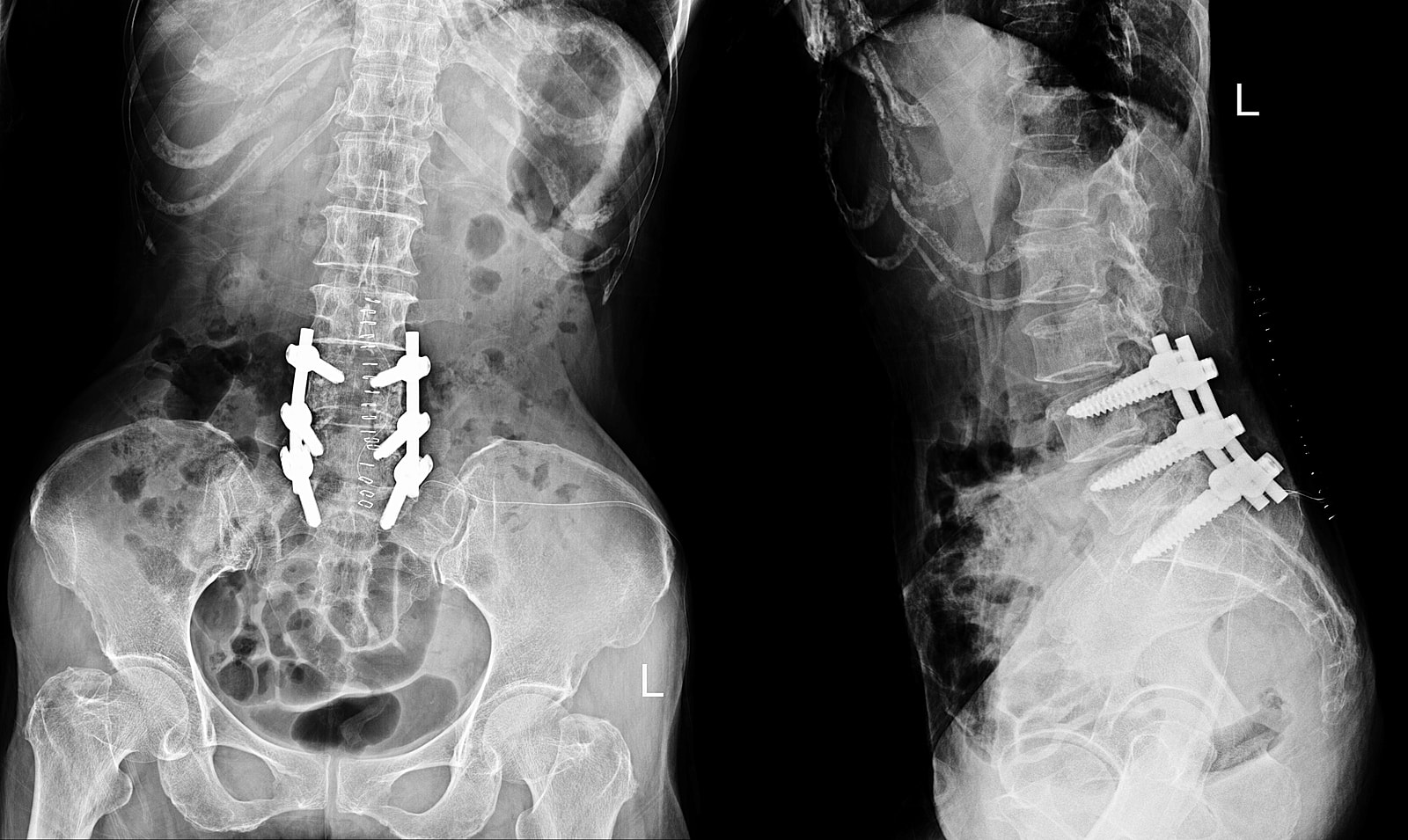 What Does it Mean to Fuse Vertebrae? A Guide to Spinal Fusion