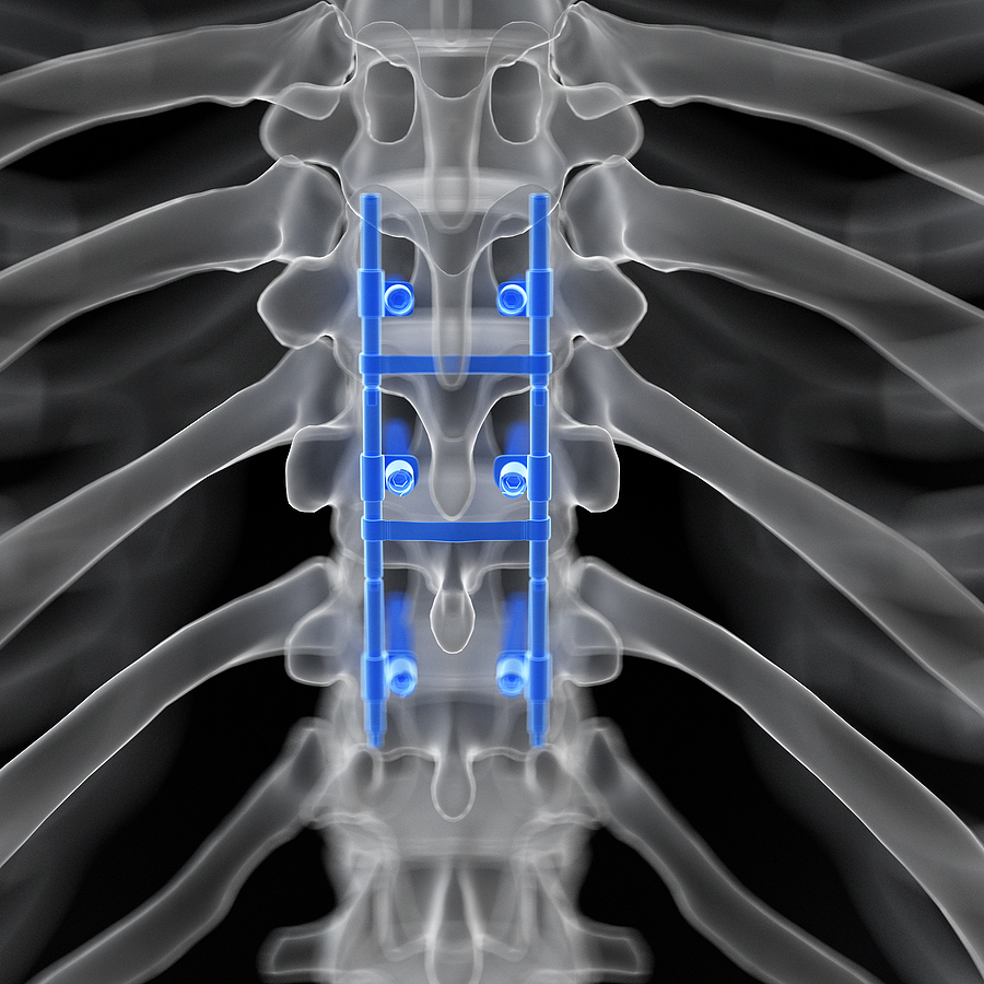 Fusion of the Spine Surgery