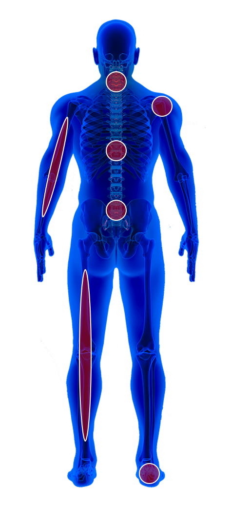 Thoracic Disc Herniation NJ & NYC