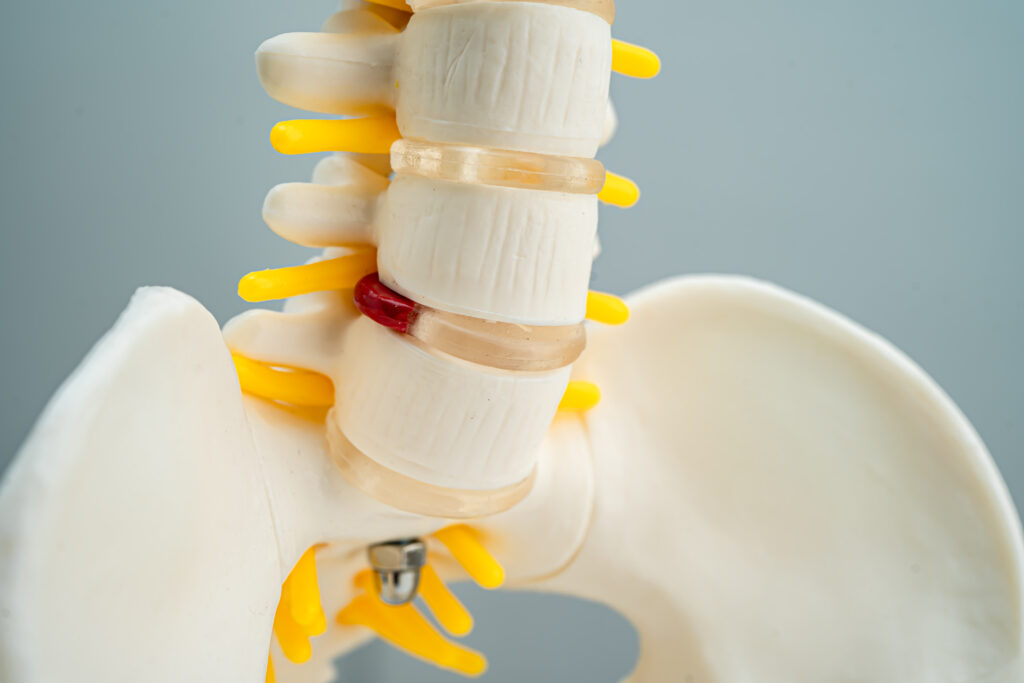 lumbar herniated disc symptoms