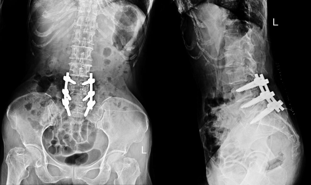 fuse vertebrae